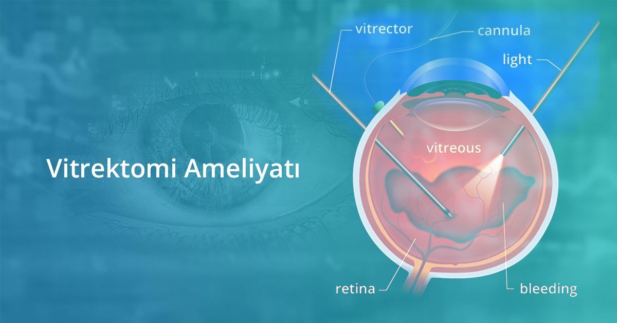 Vitrektomi Nedir?