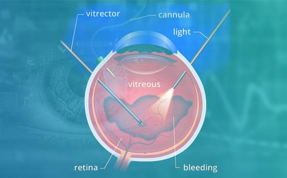 Vitrektomi Nedir?