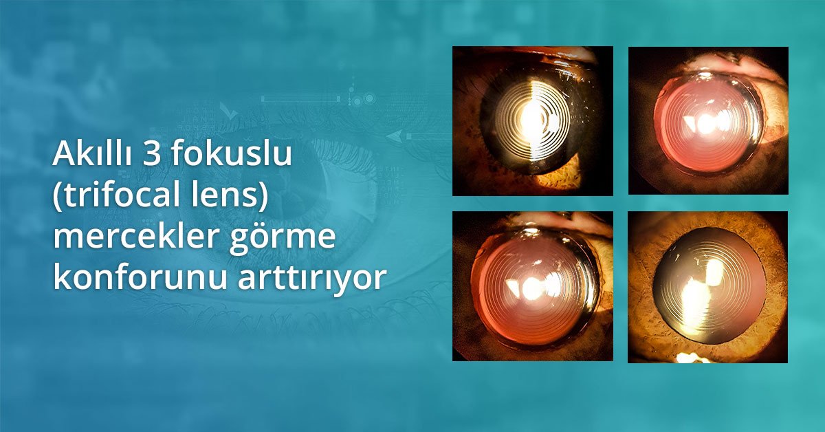 Akıllı Mercek (Trifokal Mercek) Nedir?