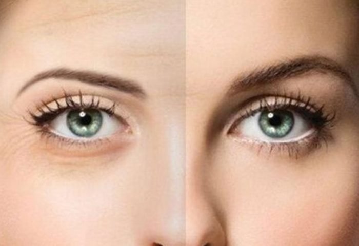 Blefaroplasti, Sarkmış Göz Kapağı Düzeltme Operasyonları